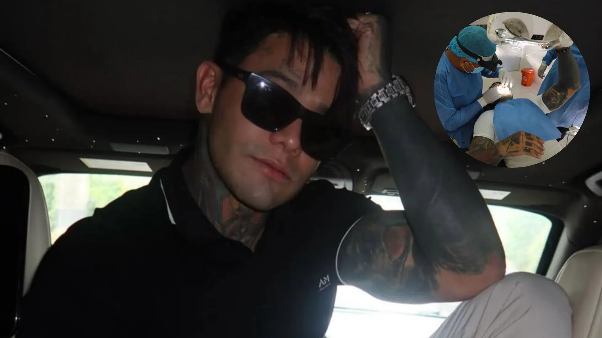 Yeferson Cossio Suffers Painful Accident in the Amazon, Undergoes Urgent Dental Intervention